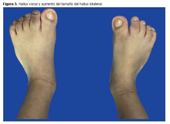 Hallux varus en el Síndrome de Apert.